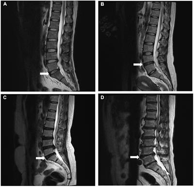 Impact of dyslipidemia on the severity of symptomatic lumbar spine degeneration: A retrospective clinical study